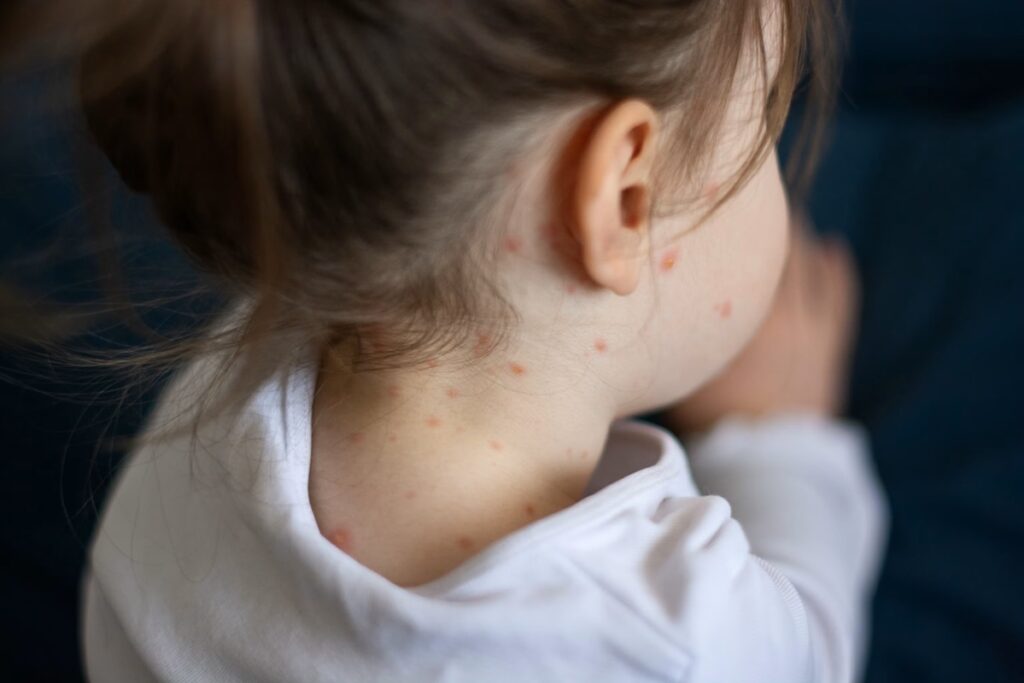 Possible Second U.S. Measles Death Reported as Outbreak Grows in Texas